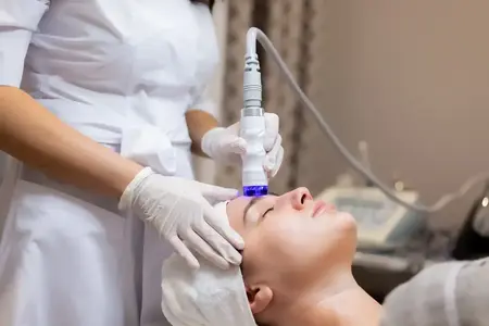 Microneedling vara Bacau realizat la MarabuCenter cu radiofrecvență fracționată